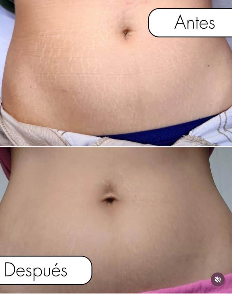 Resultado de Mejora progresiva de textura