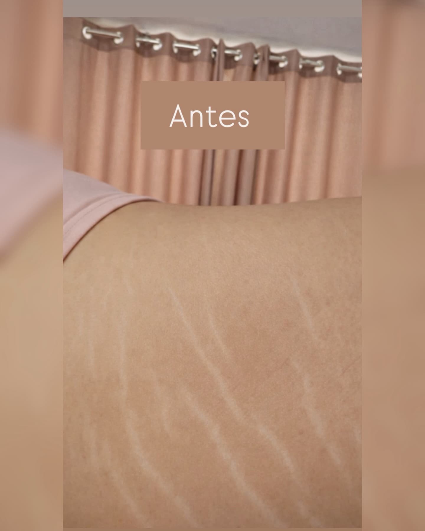 Antes de Evolución en estrías blancas