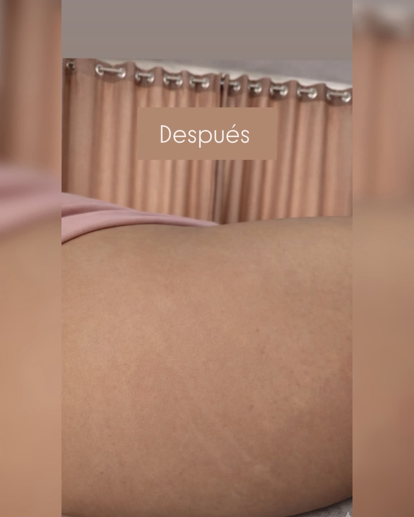 Después de Evolución en estrías blancas