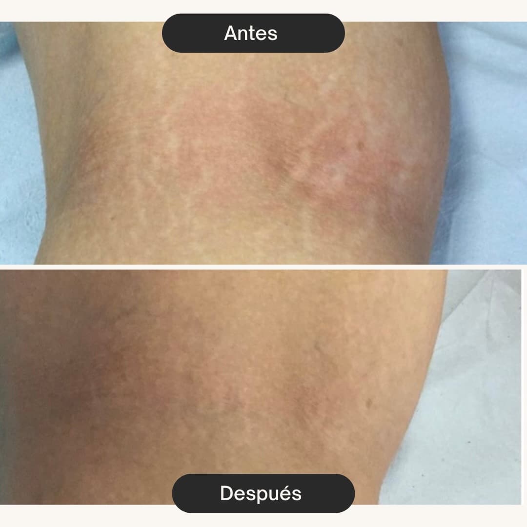 Resultado de Inicio del proceso regenerativo
