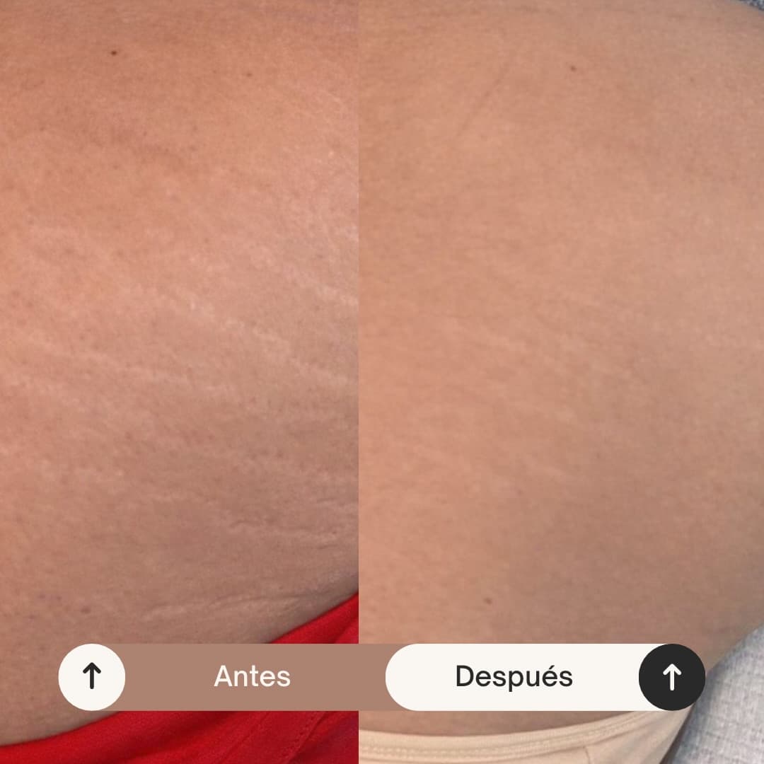 Resultado de Reducción visible y recuperación de firmeza